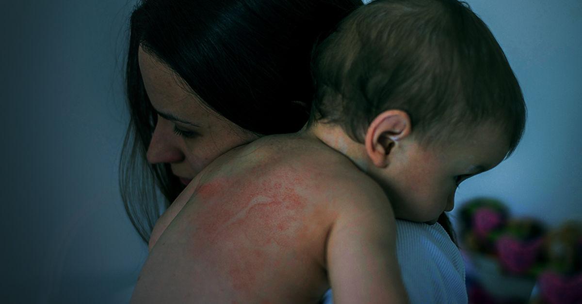 prevention and solutions for eczema