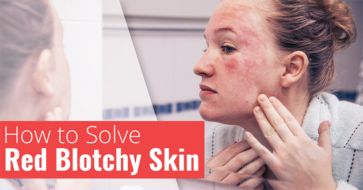 How to Solve Red Blotchy Skin Header