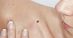 Melanoma And The Foods That Can Help You Prevent It