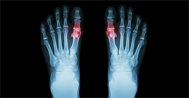 Natural Solutions to Ease Gout